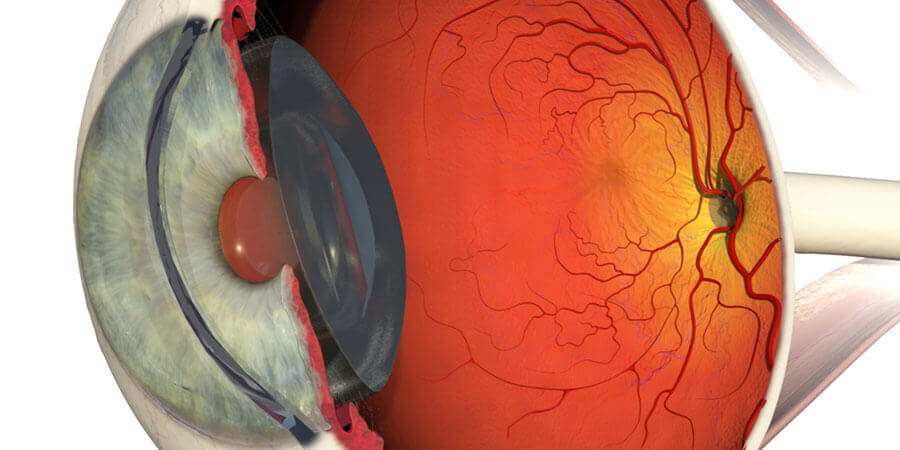 cirurgia da retina em curitiba