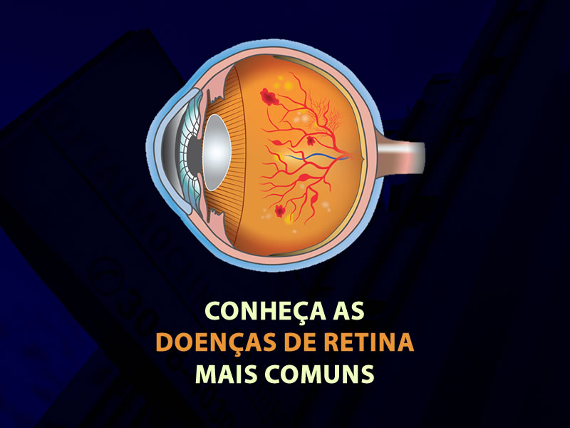 doenças de retina mais comuns