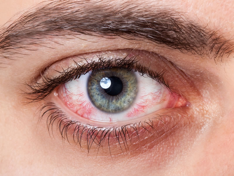 doenças raras que afetam a retina
