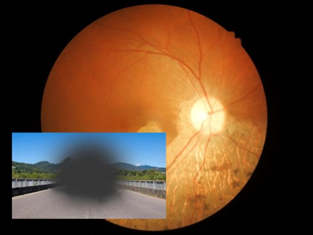 buracos escuro na visão buraco macular tratamento de retina em curitiba para buracos maculares