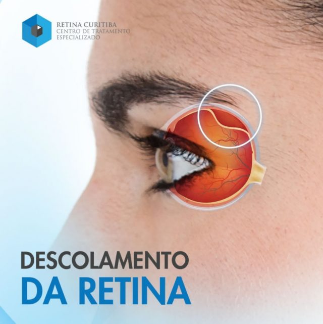 descolamento de retina curitiba