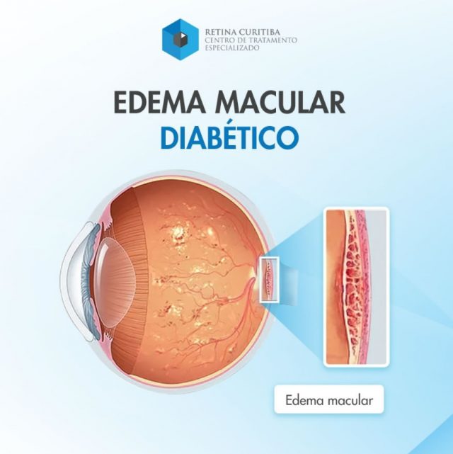 edema macular diabetico retina curitiba