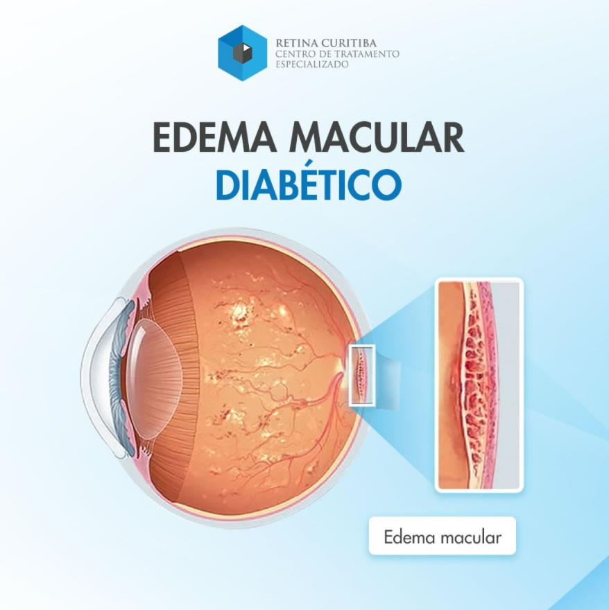edema macular diabetico retina curitiba