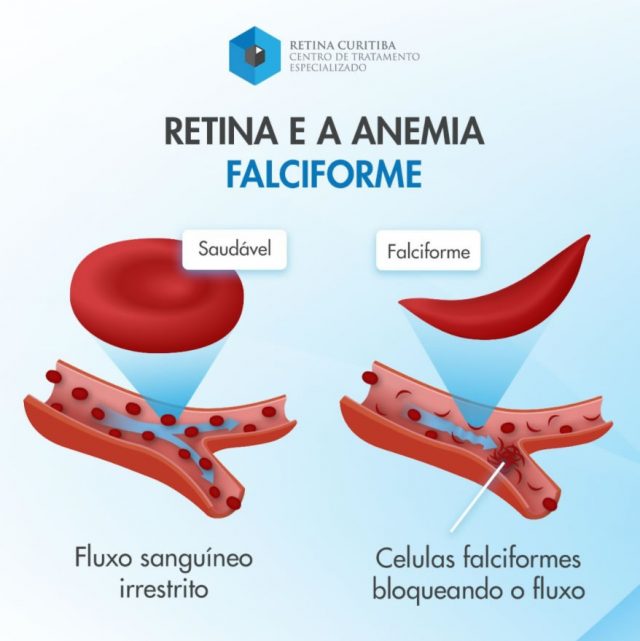 retina curitiba e anemia falciforme
