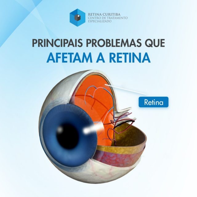 Tratamento de Doenças de Retina em Curitiba Conheça as principais doenças que afetam a Retina