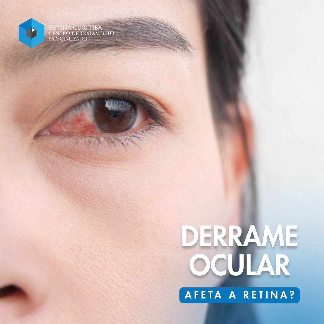 Tratamento de Derrame Ocular em Curitiba