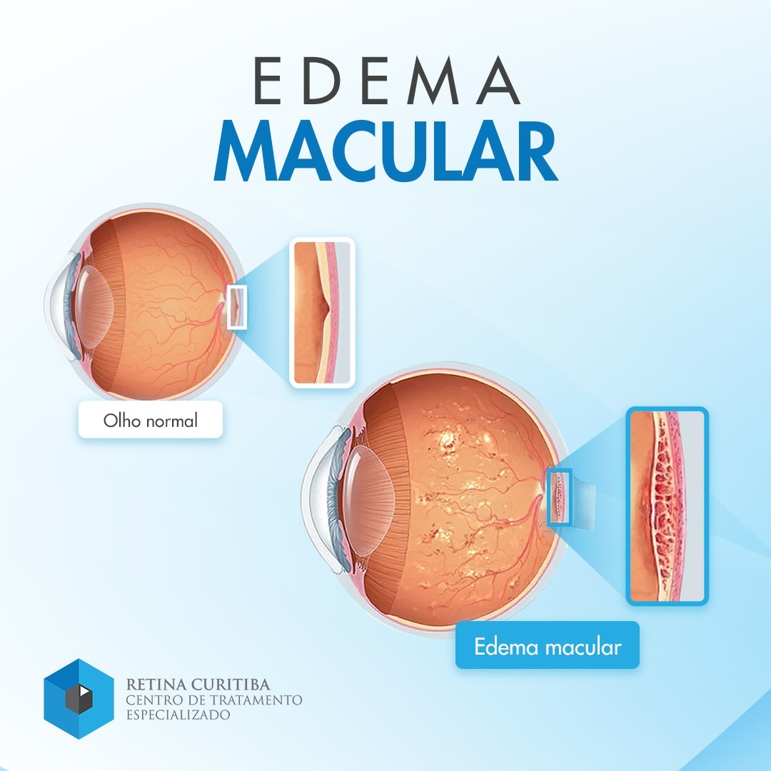 Tratamento de Edema Macular de Retina em Curitiba