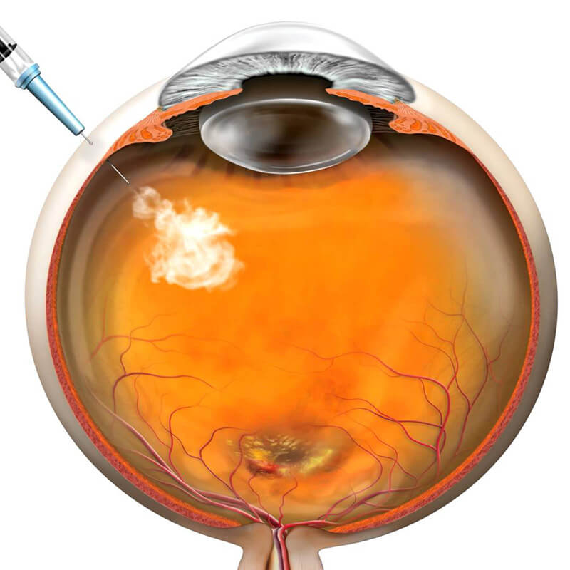 Injeção Intravítrea para DMRI Injeção no olho é um tratamento importante para doenças graves da retina