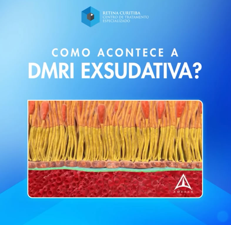 Tratamento da DMRI Exsudativa em Curitiba