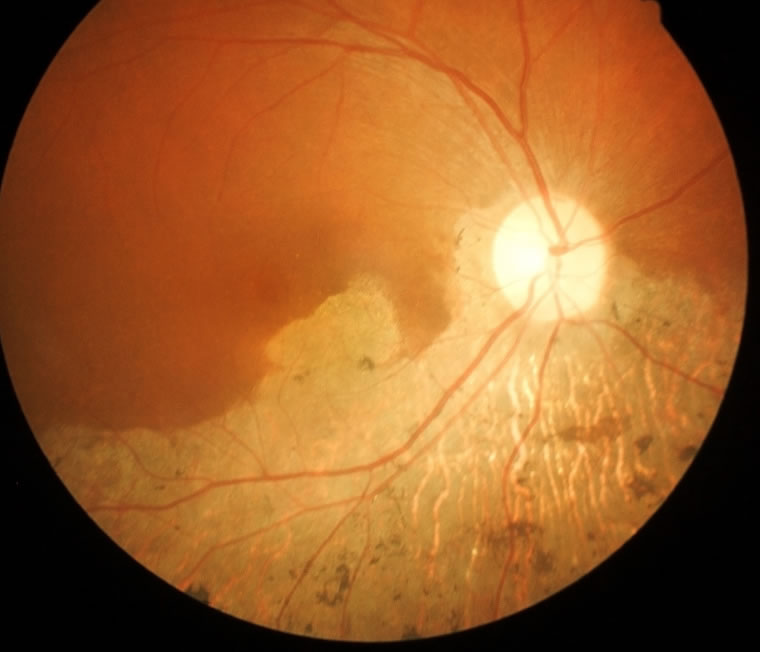 edema macular diabetico curitiba tratamento avançado de retina especialista