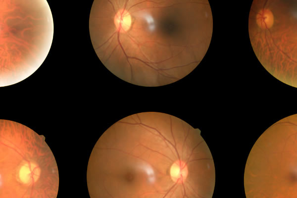 Exame de Fundoscopia do Olho em Curitiba
