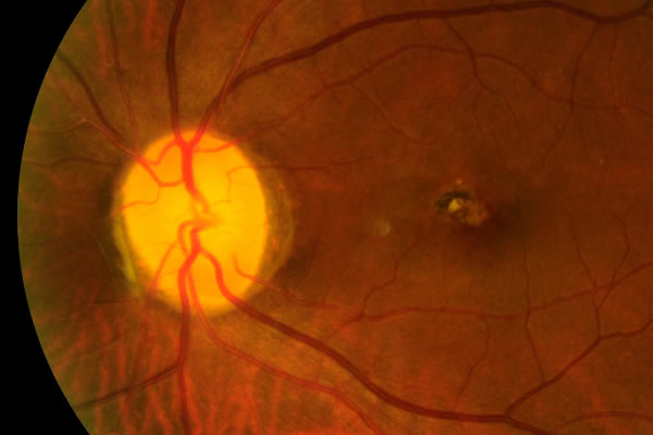 mapeamento de retina em curitiba onde realizar o exame